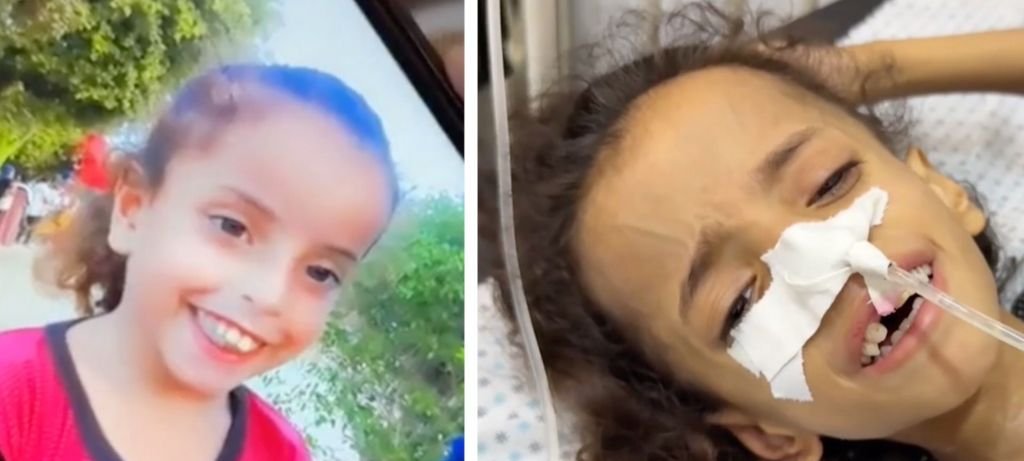 Fome em Gaza faz peso de criança cair pela metade Fome em Gaza faz peso de criança cair pela metade