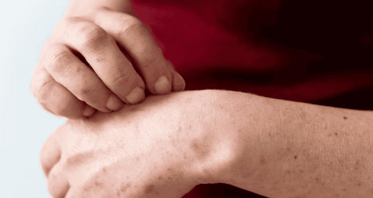 Doenças autoimunes: 10 tipos principais e sinais de alerta Doenças autoimunes: 10 tipos principais e sinais de alerta