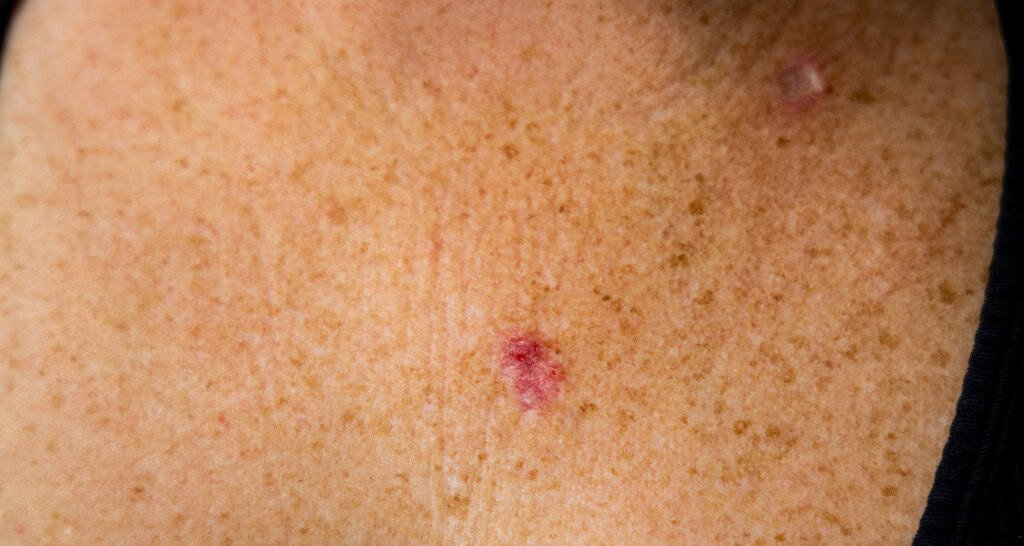 Câncer de pele: como prevenir após diagnóstico de Bolsonaro