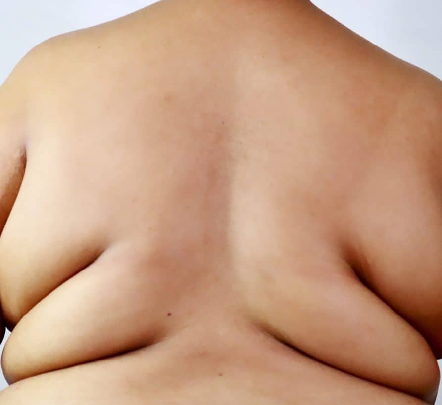 Obesidade acelera progressão do câncer de endométrio Obesidade acelera progressão do câncer de endométrio