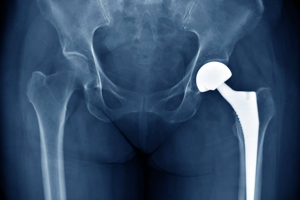 Metal líquido revoluciona combate a infecções em implantes Metal líquido revoluciona combate a infecções em implantes