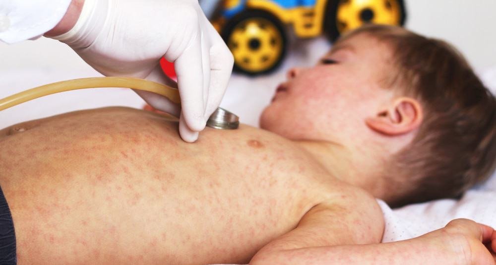 Casos de sarampo acendem alerta e vacinação cai no Brasil Casos de sarampo acendem alerta e vacinação cai no Brasil