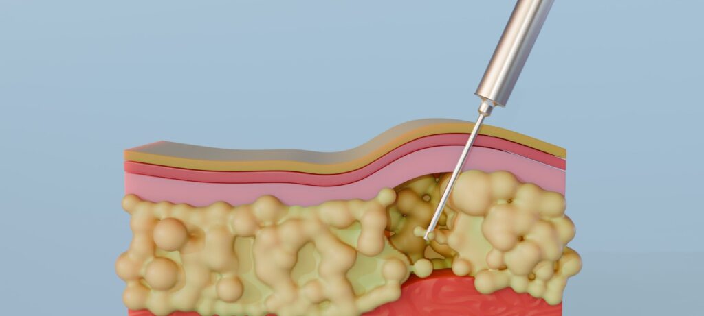 Lipoaspiração: riscos, benefícios e cuidados essenciais Lipoaspiração: riscos, benefícios e cuidados essenciais